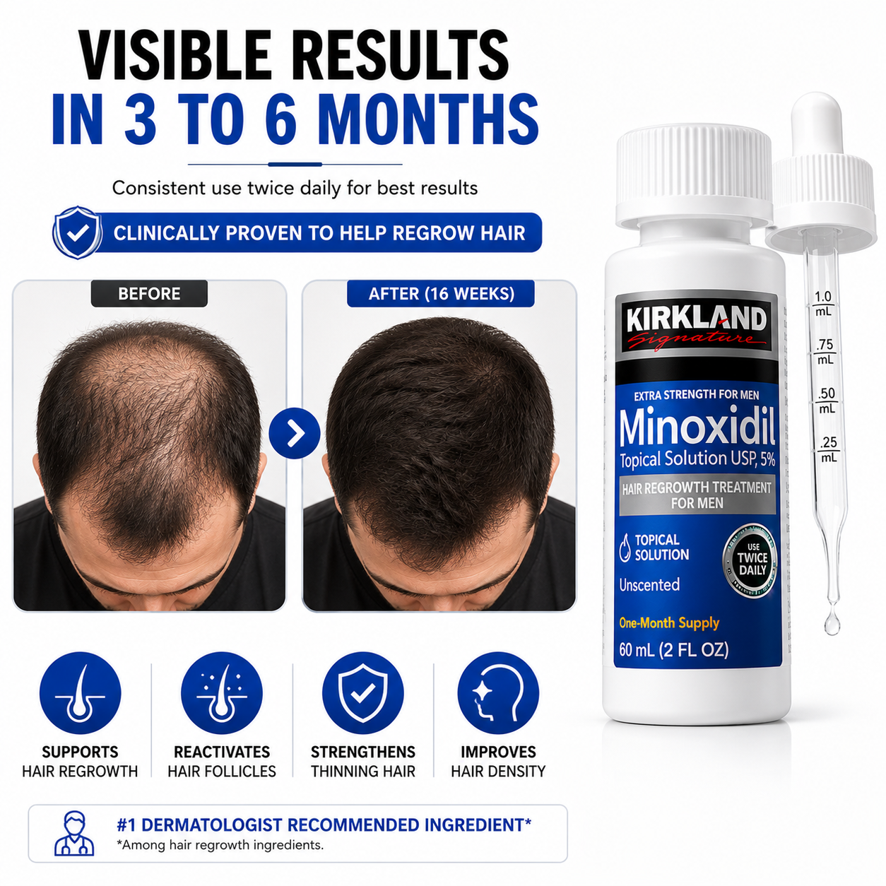 Minoxidil for Men – 6-Month Hair Regrowth Treatment Kit